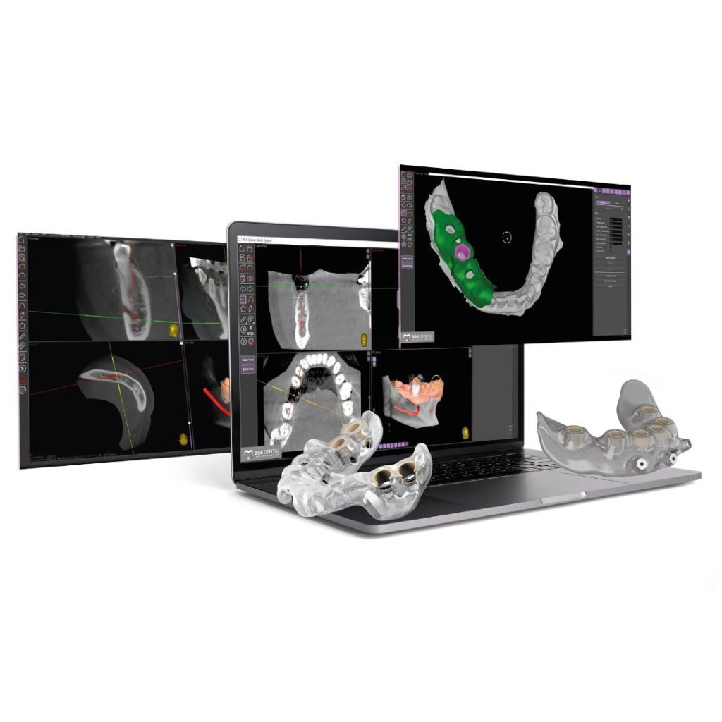 Implantologia computer guidata 1 Implantologia computer guidata