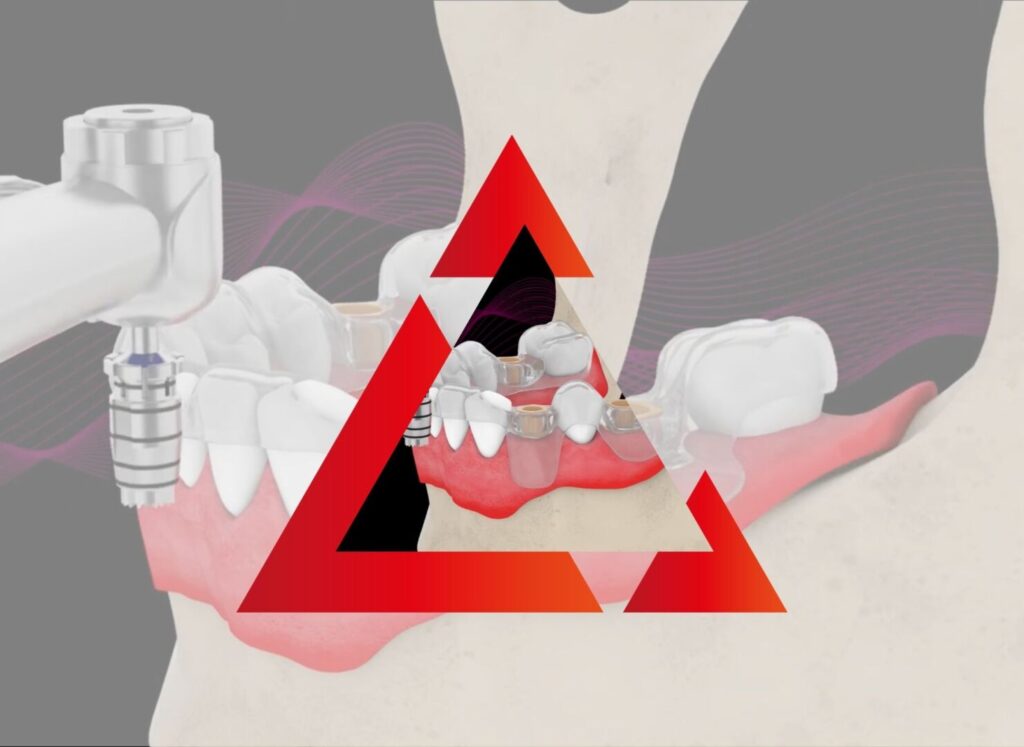 Pianificazione 3D Impianto Dentale