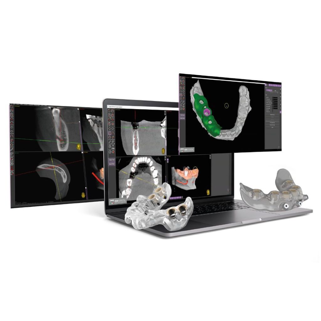 Implantologia computer guidata 13 Aida Implantologia portale informativo | dentista implantologo