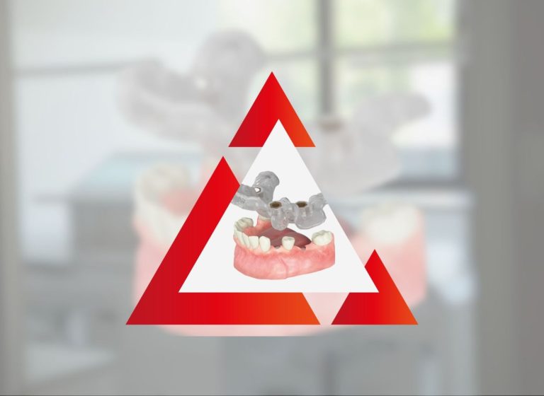 Implantologia guidata computerizzata: Cos’è e Come Funziona