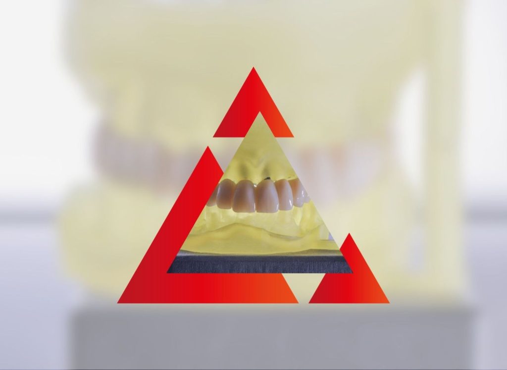 Implantologia Totale a Carico Immediato: Vantaggi e Funzionamento